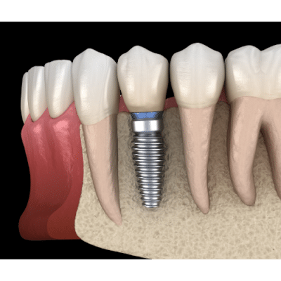 Single Tooth Dental Implant