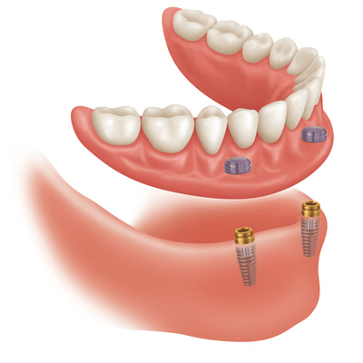 Implant Retained Dentures 